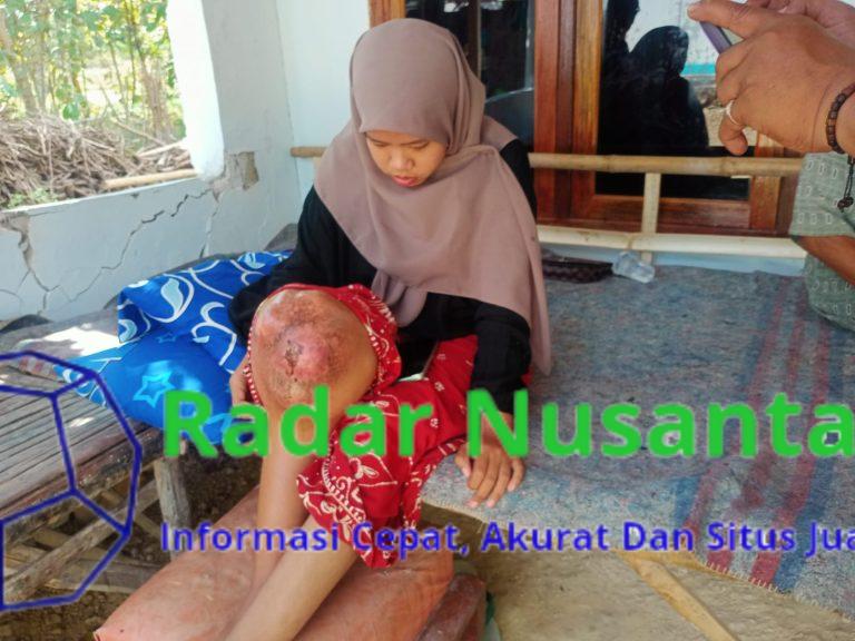 Mahasiswi IAIN Madura Diduga Derita Kanker Ganas, Keluarga Kesulitan Biaya